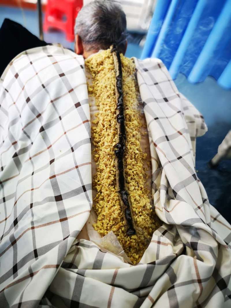 火龍罐治療.jpg